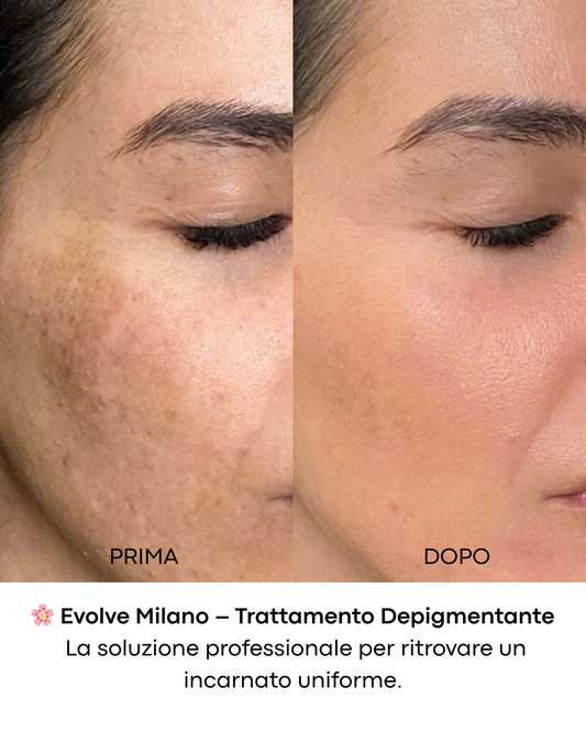 Depigmentazione viso a Milano: la soluzione avanzata di Evolve Clinica Estetica
