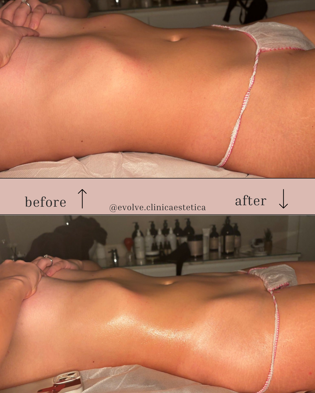 Prima e Dopo: Perdi una Taglia in Sole 3 Sedute