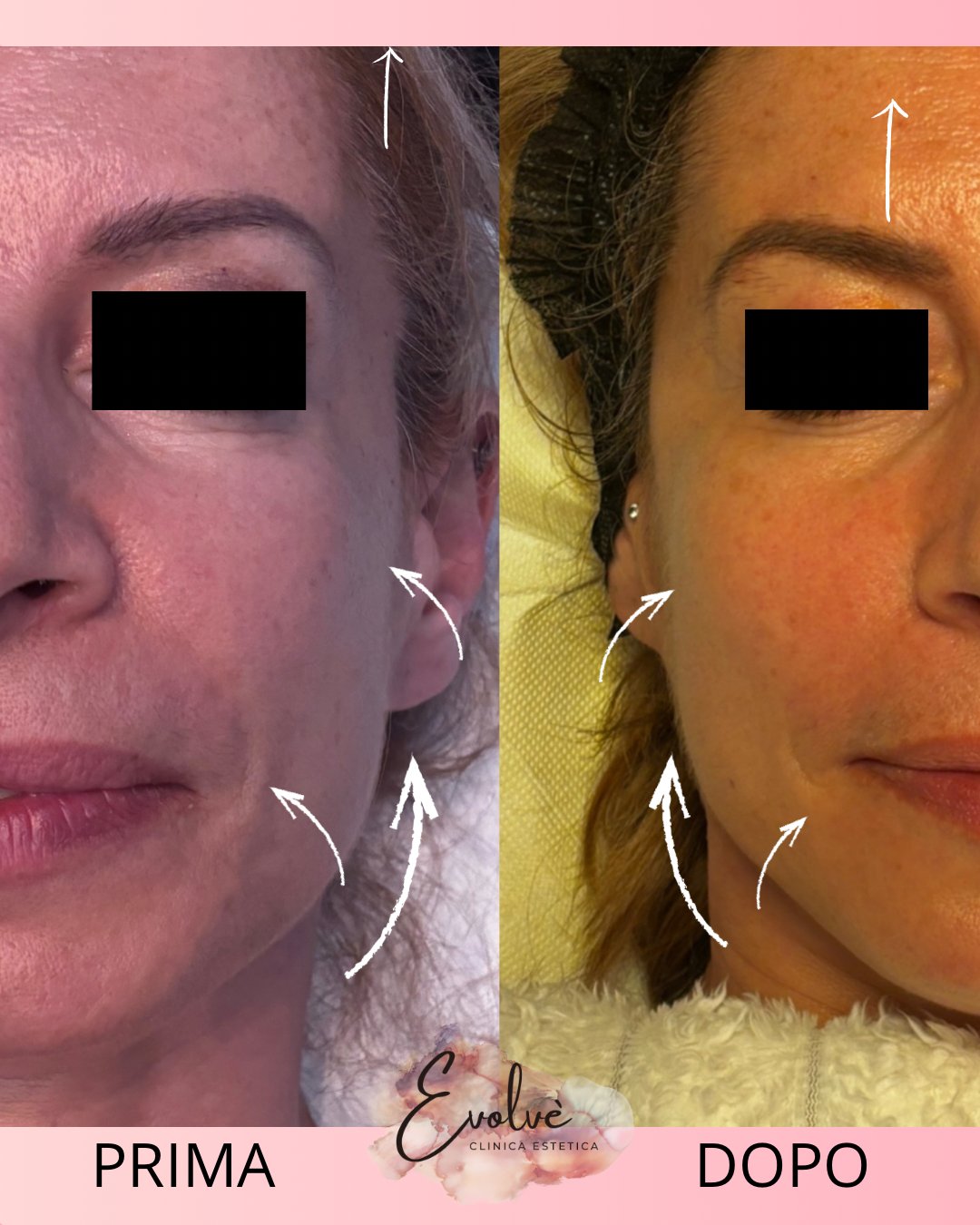 Trattamento Anti-Age con Esosomi a Milano – Risultati visibili nel nostro centro estetico in via Cenisio