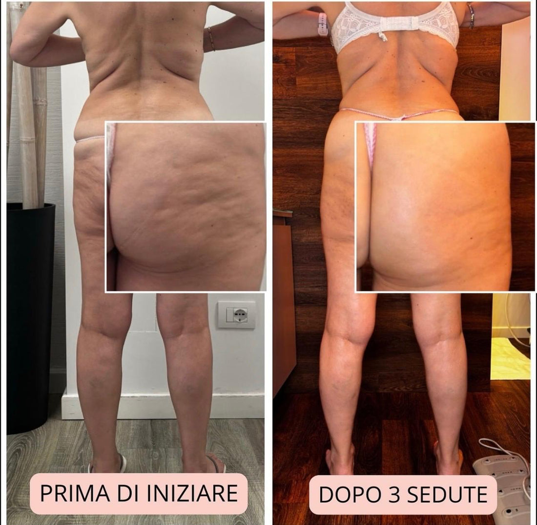 Ritenzione Idrica: Come Combatterla con i Trattamenti Estetici Giusti