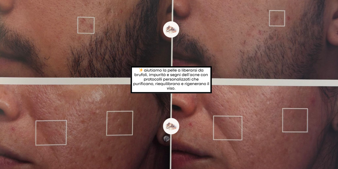 Trattamenti anti-acne a Milano: la soluzione avanzata di Evolve Clinica Estetica